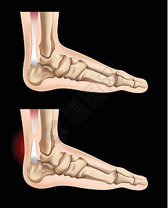 人脚和肌腱损伤图片