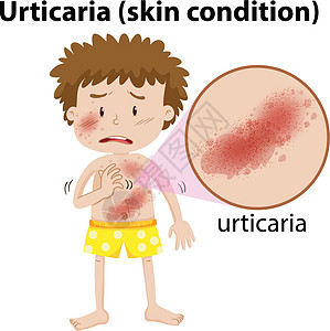 患有荨麻疹的年轻人图片