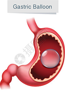 人体解剖学胃气球它制作图案图片