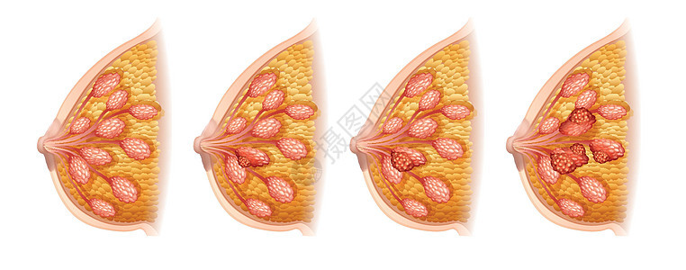 显示人类乳腺癌的图表图片