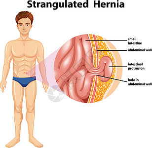 绞窄性 Herni 的人体解剖学图片