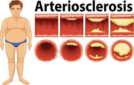 一个患有动脉粥样硬化的胖子图片