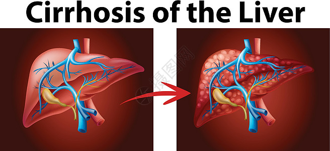 显示肝硬化的图表图片