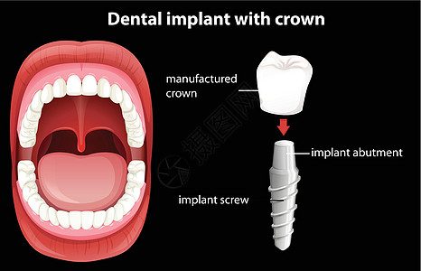 牙种植体的医学载体图片