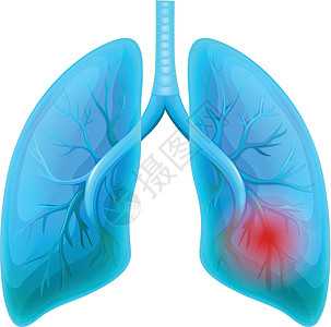 白色背景上的肺部疾病图片