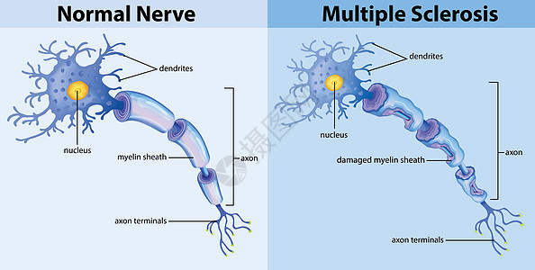正常神经和多发性硬化症图片