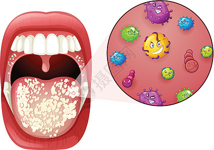 人类口腔病毒感染空腔流感药品科学癌症微生物夹子怪物牙医发烧图片