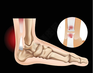 有撕裂肌腱的人脚图片