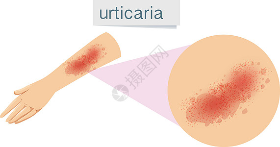 人类皮肤问题荨麻疹背景图片