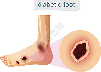 在 foo 上放大的糖尿病足图片