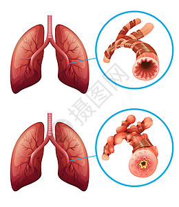 显示肺部疾病的图表人体技术癌症医生白色科学小路生物学健康插图图片
