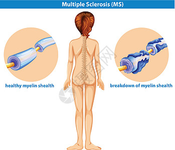 多发性硬化症的医学载体图片
