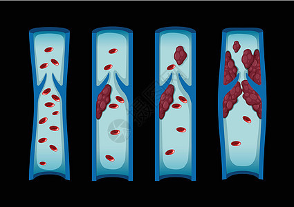 人类血液中不同阶段的血凝块图片