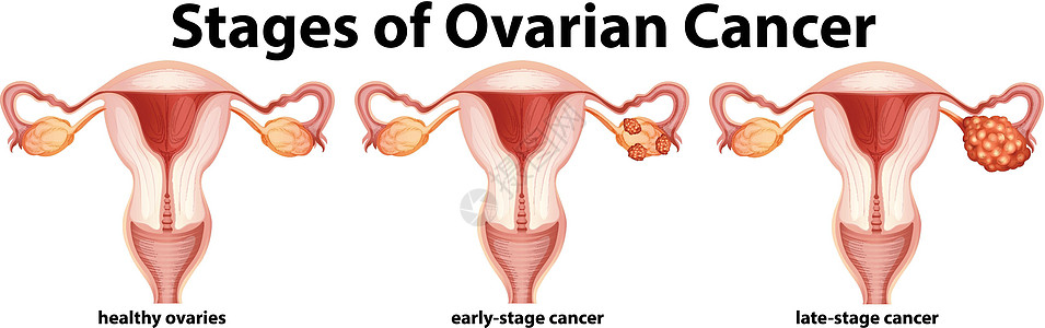 显示卵巢癌分期的图表图片