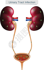 白底尿路感染身体膀胱科学插图手术解剖学女性药品艺术海报图片