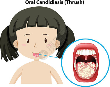 女孩口腔念珠菌病图片