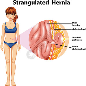 女人绞窄性疝气图片