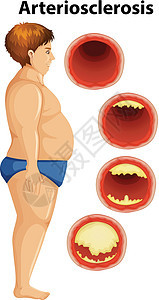 胖子与动脉硬化图片