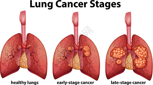 显示肺癌分期的图表图片