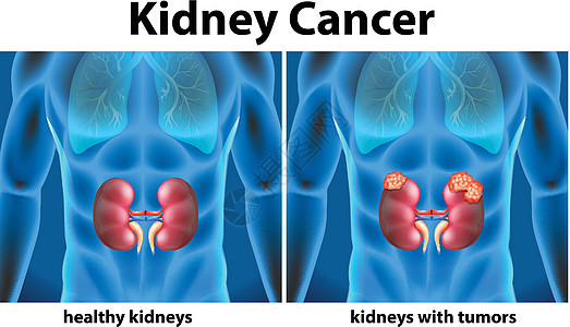 显示人类肾癌的图表医生医疗插图人体解剖学疾病科学健康器官绘画图片