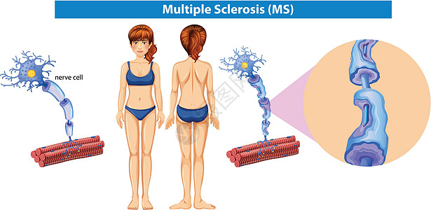多发性硬化症的人体解剖学饮食夹子插图食品艺术健康功能绘画脂肪酸神经系统图片