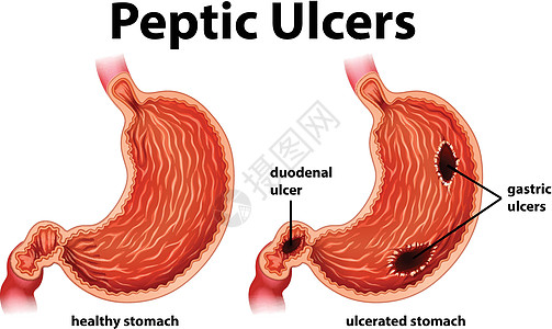 图表显示消化性溃疡图片