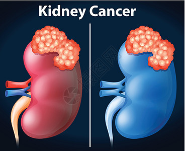 肾癌两图图片