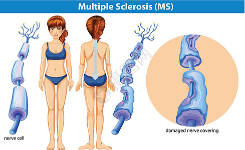 多发性硬化症的人体解剖学心理饮食脑脂肪健康脑雾神经元精神夹子绘画脂肪酸图片
