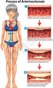 动脉硬化医学插图的过程图片