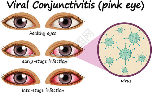带有病毒性结膜炎的人类眼病图片