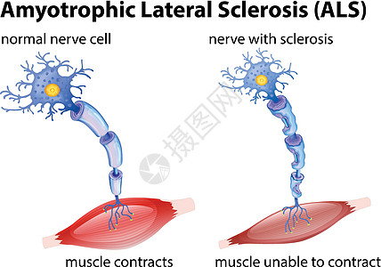 肌萎缩侧索硬化概念图片