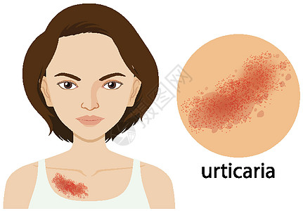 显示人类女性荨麻疹的图表图片