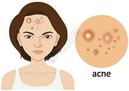 图表显示有粉刺问题的女性图片