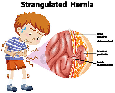 diagra 绞窄性疝气的男孩图片