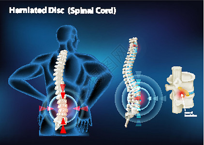 显示人体椎间盘突出的图表保健卫生艺术科学女性男性女孩脊柱生理疾病图片