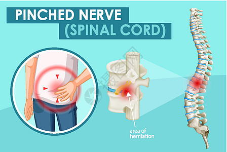 图表显示人类受压的神经男性解剖学女性疝气绘画骨骼生物学艺术科学男人图片