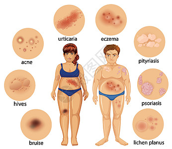 显示不同皮肤病的图表图片