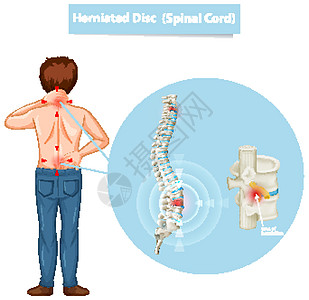 显示椎间盘突出的示意图病理生物学绘画脊柱疾病男性卫生身体解剖学插图图片