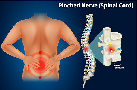 显示受压神经的图表脊柱骨骼生理插图夹子科学男人生物学微生物学艺术图片