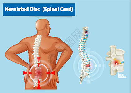 显示人体椎间盘突出的图表病理微生物学神经男性夹子生物学男人疾病脊柱卡通片图片