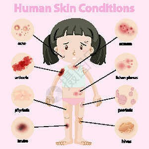 显示人体皮肤状况的图表生物学男性解剖学孩子卫生插图保健药品荨麻疹粉刺图片