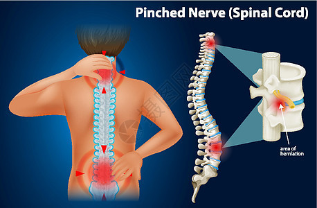 显示受压神经的图表卡通片生物学男人医疗插图夹子脊柱药品绘画科学图片