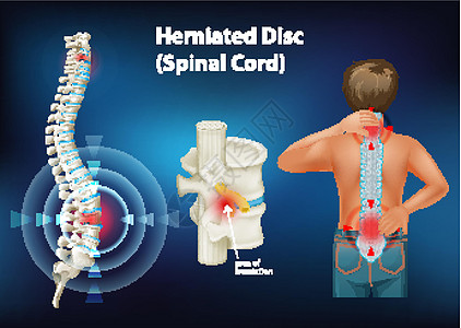 显示椎间盘突出的示意图解剖学疾病男性神经绘画脊柱女性药品科学生理图片