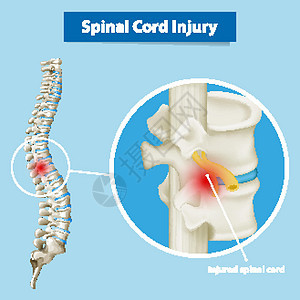 显示脊髓损伤的图表插图卡通片微生物学科学病理脊柱生理绳索男人神经图片