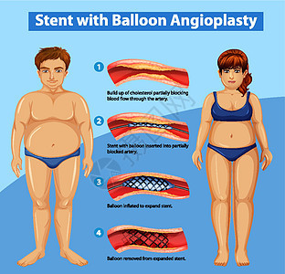 显示带有球囊血管成形术的支架的图表图片