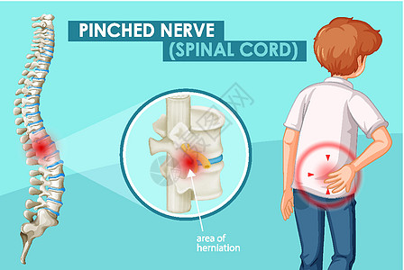 显示受压神经的图表女性骨骼微生物学疾病生物学保健男性插图药品科学图片