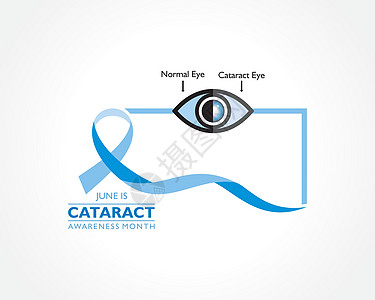 月观察到的白内障宣传月的矢量图解眼睛疾病症状活动预防鸢尾花插图国家外科丝带图片