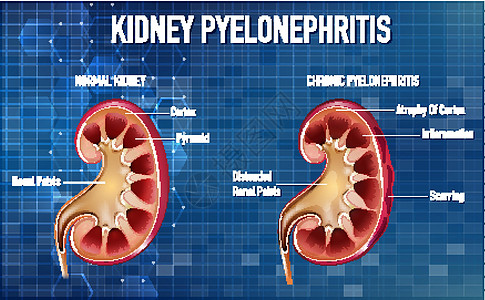 肾盂肾炎的资料图生物学肾盂图表学习科学金字塔器官疤痕绘画病理图片