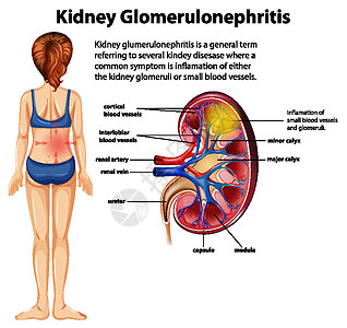 肾小球硬化的医学信息图药品症状疼痛保健科学血管女士艺术微生物学绘画图片