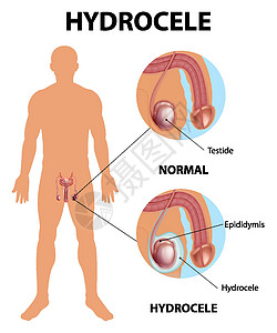 显示男性正常睾丸和鞘膜积液之间差异的医学海报疼痛绘画插图症状卡通片信息学习状况疾病药品图片